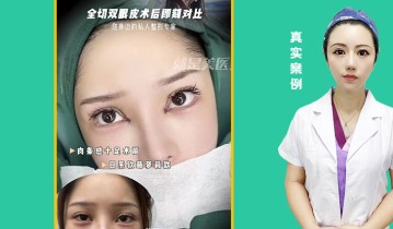 全切双眼皮术后即可对比