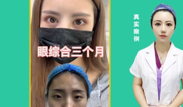 眼综合3个月效果