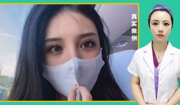 徐丽芬医生-黄金媚眼重睑术效果