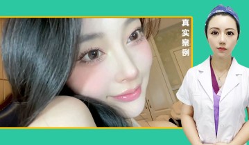 黄金媚眼重睑术效果【2】